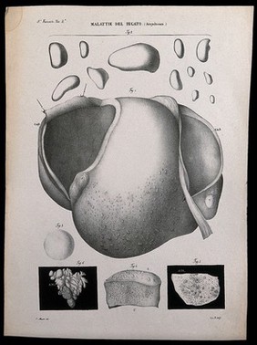 Several sections of diseased liver, numbered for key. Lithograph by Ridolfi after Ottavio Muzzi, c. 1843.