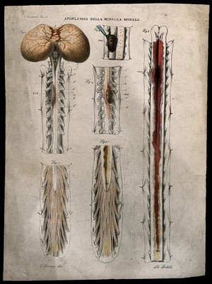 view Several sections of diseased spinal cord showing blood clots and haemorrhage, numbered for key. Coloured lithograph by Batelli after Ferdinando Ferrari, c. 1843.