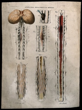 Several sections of diseased spinal cord showing blood clots and haemorrhage, numbered for key. Coloured lithograph by Batelli after Ferdinando Ferrari, c. 1843.
