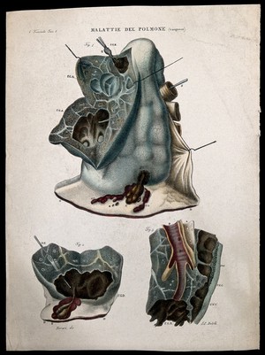 view Three sections of diseased lungs, numbered for key. Coloured lithograph by Batelli after Ferdinando Ferrari, c. 1843.