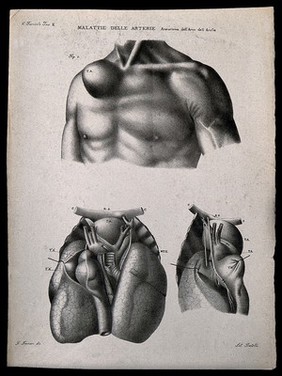 Three examples of diseased blood vessels of the heart, numbered for key. Lithograph by Batelli after Ferdinando Ferrari, c. 1843.
