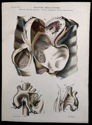 view Three examples of diseased arteries of the heart, numbered for key. Coloured lithograph by Batelli after Ferdinando Ferrari, c. 1843.
