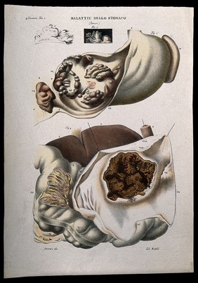 Four sections of diseased stomach (cancer), numbered for key. Coloured lithograph by Batelli after Ferdinando Ferrari, c. 1843.