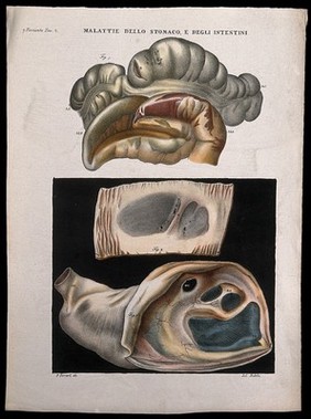 Three sections of diseased stomach and intestines, numbered for key. Coloured lithograph by Batelli after Ferdinando Ferrari, c. 1843.