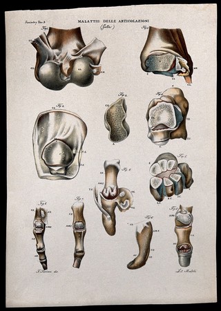 Several examples of diseased joints (gout), numbered for key. Coloured lithograph by Batelli after Ferdinando Ferrari, c. 1843.