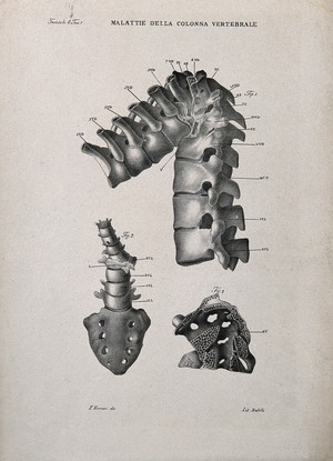 view Three examples of diseased spine, numbered for key. Lithograph by Batelli after Ferdinando Ferrari, c. 1843.