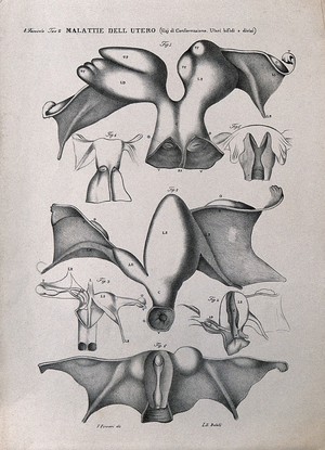 view Several sections of diseased uterus, numbered for key. Lithograph by Batelli after Ferdinando Ferrari, c. 1843.