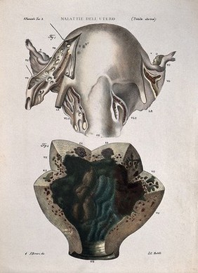 Two sections of diseased uterus, numbered for key. Coloured lithograph by Batelli after Ferdinando Ferrari, c. 1843.