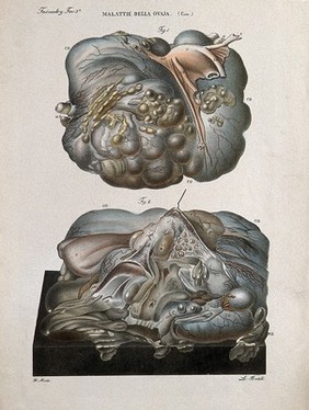 Two sections of diseased ovary (cysts), numbered for key. Coloured lithograph by Batelli after Ottavio Muzzi, c. 1843.