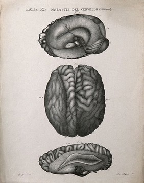 Three sections of diseased brain, numbered for key. Lithograph by Batelli after Ferdinando Ferrari, c. 1843.