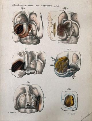 Several sections of diseased brain, numbered for key. Coloured lithograph by Batelli after Ferdinando Ferrari, c. 1843.