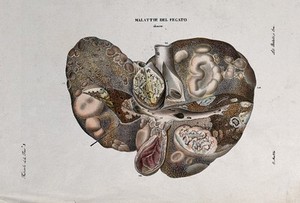 view A cross-section of diseased liver (cancer), numbered for key. Coloured lithograph by Batelli after O. Muzzi, c. 1843.