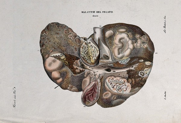 A cross-section of diseased liver (cancer), numbered for key. Coloured lithograph by Batelli after O. Muzzi, c. 1843.