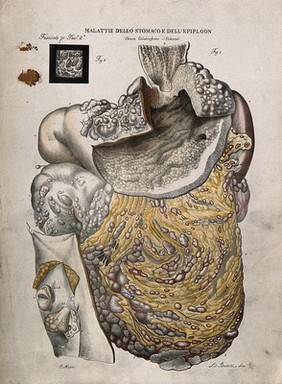 A diseased stomach, numbered for key. Coloured lithograph by Batelli after O. Muzzi, c. 1843.