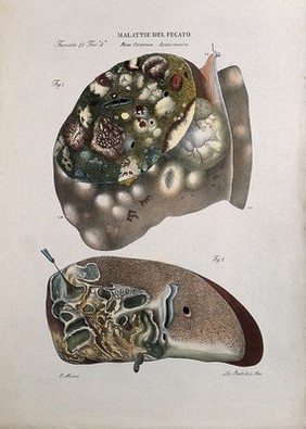 Two sections of diseased liver (cancer), numbered for key. Coloured lithograph by Batelli after O. Muzzi, c. 1843.