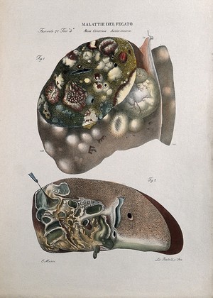 view Two sections of diseased liver (cancer), numbered for key. Coloured lithograph by Batelli after O. Muzzi, c. 1843.