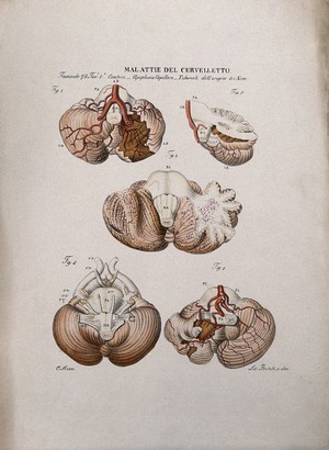 view Five sections of diseased brain, numbered for key. Coloured lithograph by Batelli after Ottavio Muzzi, c. 1843.