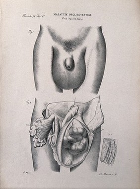 Male genitalia with enlarged scrotum; and a dissected scrotum and groin showing hernia, numbered for key. Lithograph by Batelli after Ottavio Muzzi, c. 1843.