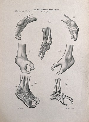 view Several examples of deformed feet, each with two pincer-like toes, numbered for key. Lithograph by Batelli after Ottavio Muzzi, c. 1843.