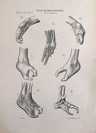 Several examples of deformed feet, each with two pincer-like toes, numbered for key. Lithograph by Batelli after Ottavio Muzzi, c. 1843.