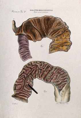Two sections of diseased intestines, numbered for key. Coloured lithograph by Batelli after Ottavio Muzzi, c. 1843.