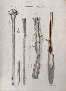 Several sections of diseased spinal cord, numbered for key. Coloured lithograph by Batelli after Ottavio Muzzi, c. 1843.