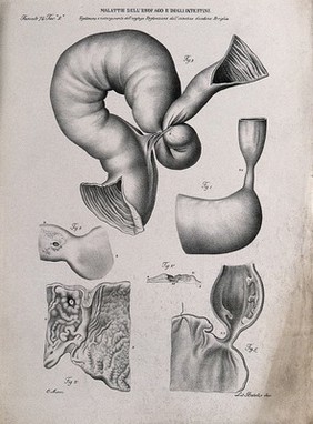 Several sections of diseased oesophagus and intestines, numbered for key. Lithograph by Batelli after Ottavio Muzzi, c. 1843.