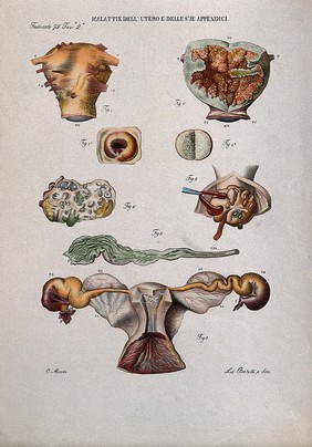 Several sections of diseased uterus and appendix, numbered for key. Coloured lithograph by Batelli after Ottavio Muzzi, c. 1843.