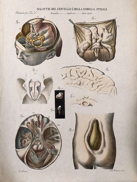Several examples of diseased brain and spinal column, numbered for key. Coloured lithograph by Batelli after Ottavio Muzzi, c. 1843.