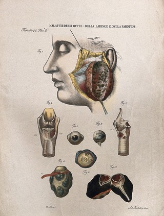 Several examples of diseased eyes, throat (larynx) and face, numbered for key. Coloured lithograph by Batelli after Ottavio Muzzi, c. 1843.