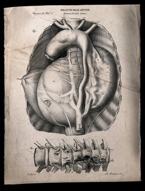 A diseased artery (aneurism of the aorta); and a diseased section of bone, numbered for key. Lithograph by Batelli after Ottavio Muzzi, c. 1843.