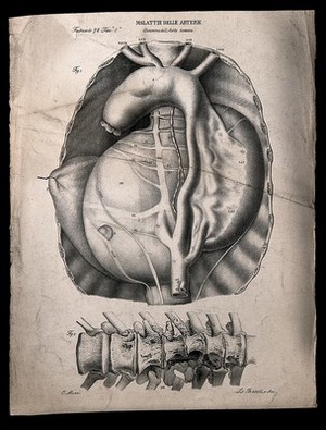 view A diseased artery (aneurism of the aorta); and a diseased section of bone, numbered for key. Lithograph by Batelli after Ottavio Muzzi, c. 1843.