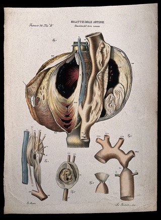 Several sections of diseased artery (aneurism of the aorta), numbered for key. Coloured lithograph by Batelli after Ottavio Muzzi, c. 1843.