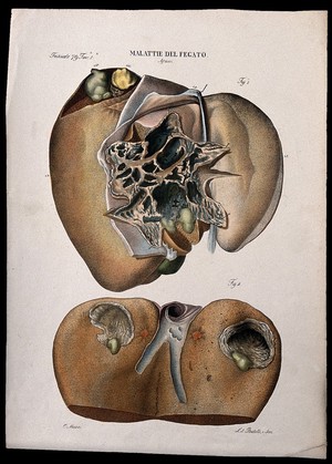 view Two sections of diseased liver (abscess), numbered for key. Coloured lithograph by Batelli after Ottavio Muzzi, c. 1843.