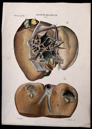 Two sections of diseased liver (abscess), numbered for key. Coloured lithograph by Batelli after Ottavio Muzzi, c. 1843.