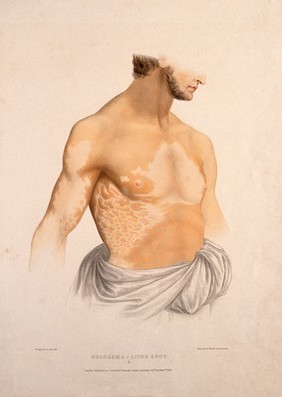 The naked torso of a man with a skin disease. Coloured lithograph by W. Bagg, 1847.