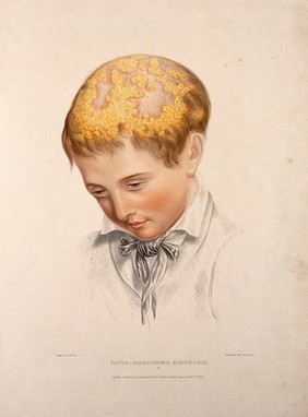 The head of a boy with a skin disease of the scalp. Coloured lithograph by W. Bagg, 1847.
