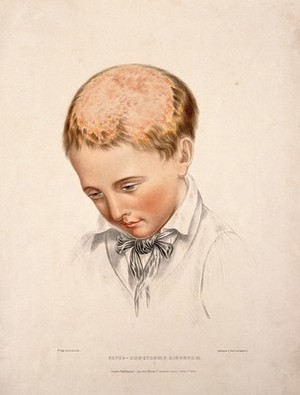 view The head of a boy with a skin disease of the scalp. Coloured lithograph by W. Bagg, 1847.