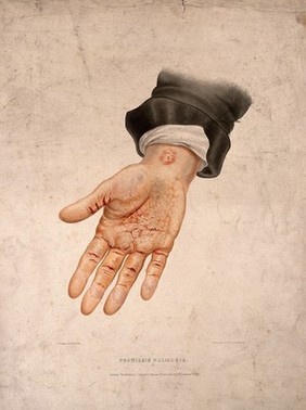 A hand with a skin disease on the palm and wrist. Coloured lithograph by W. Bagg, 1847.