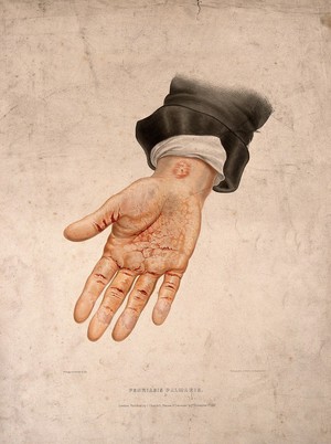 view A hand with a skin disease on the palm and wrist. Coloured lithograph by W. Bagg, 1847.