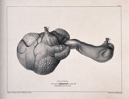 A diseased part of the body. Lithograph by W. Walton after Franz Bauer.