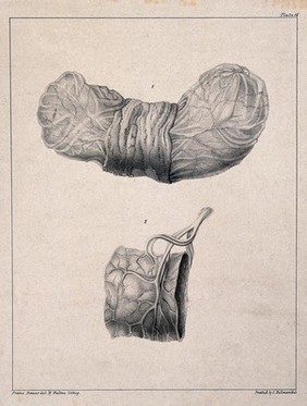 A diseased part of the body. Lithograph by W. Walton after Franz Bauer.