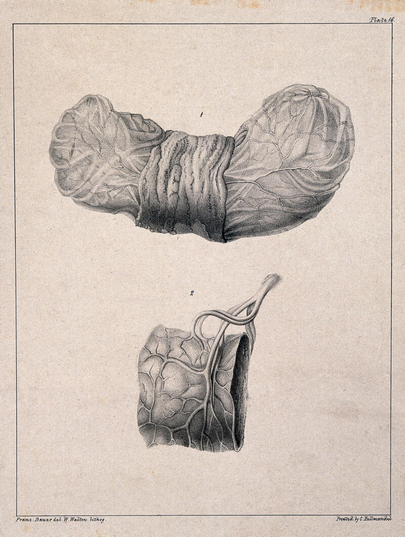 A diseased part of the body. Lithograph by W. Walton after Franz Bauer., 1847, by Franz Bauer