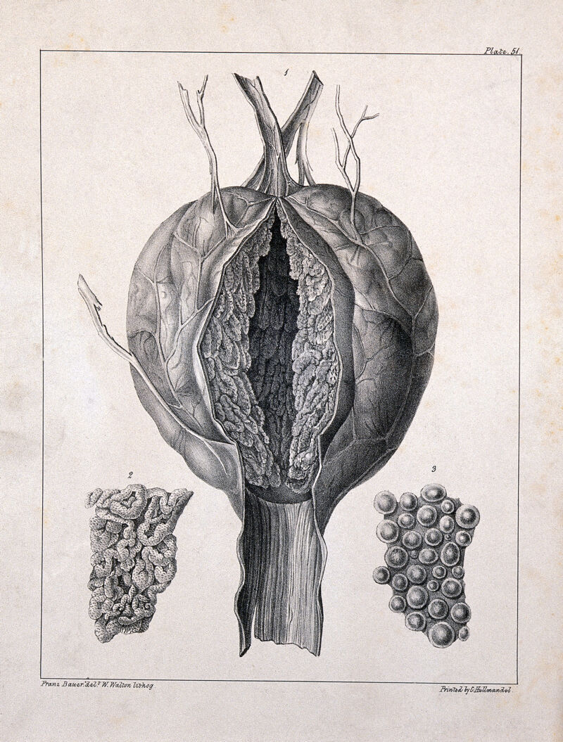 A diseased part of the body. Lithograph by W. Walton after Franz Bauer., 1847, by Franz Bauer
