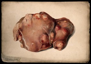 view A diseased part of the body. Watercolour by Juan Wandesforde, 1844.