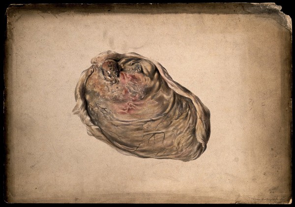 A diseased part of the body. Watercolour by Juan Wandesforde, 1844.