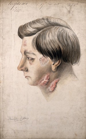 view Head of a man with a severe disease affecting his face and neck. Watercolour drawing by Christopher D' Alton, 1856.