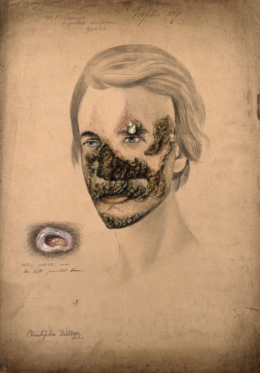 Syphilis; severe lesions on face, 1855