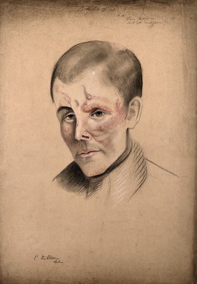 Head of a man with a severe disease affecting his face. Drawing by Christopher D' Alton, 1862.