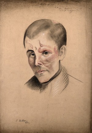 view Head of a man with a severe disease affecting his face. Drawing by Christopher D' Alton, 1862.